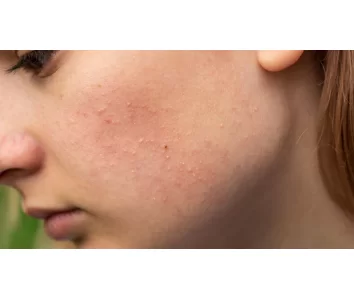 COMPILATION OF THE BEST ACNE CREAM