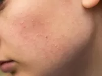 TỔNG HỢP KEM TRỊ MỤN TỐT NHẤT